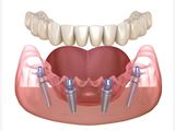 All-on-4 dental implants | Dental smile makeover |
